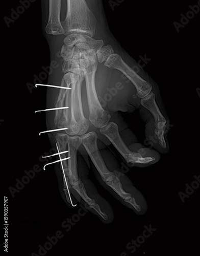 Internal fixation in manus or hand  X-ray of fractured hand that has been fixed with Internal fixation to stabilize bone fractures and promote healing	