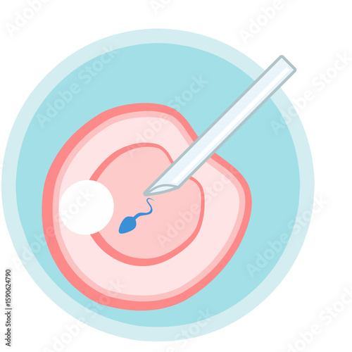 IVF ICSI vector illustration. Perfect for presenting anything about reproduction, insemination or ivf. Vertical position with blue background.