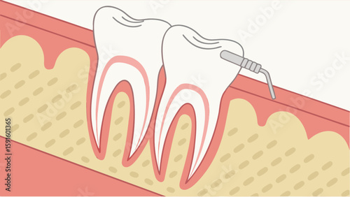 Dental root canal treatment procedure illustration for dental health education and information purposes only
