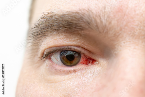 Close up of male eye with red blood vessels and irritation, showing symptom of conjunctivitis, eye infection or dry eye condition
