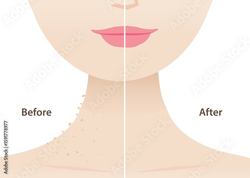 Comparison of before and after skin tags remover side of neck woman vector illustration. Skin tags are small excess pieces of skin that protrude from surface skin. Skin care and beauty concept.
