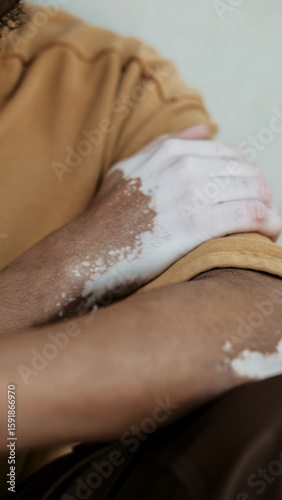 Close-up of vitiligo skin on arm, person gently holding their shoulder in comfort