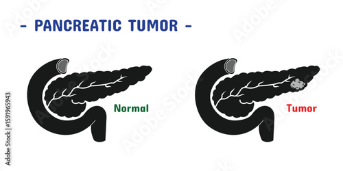 pancreatic tumor set design. medical and health care. Black style.
