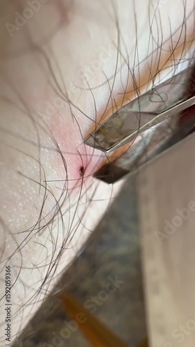 tick being pulled out of arm with tweezers