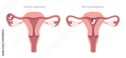 Medical infographic on the topic of ectopic and normal pregnancy. Fertilization and related problems, gynecology, fertility. Vector illustration