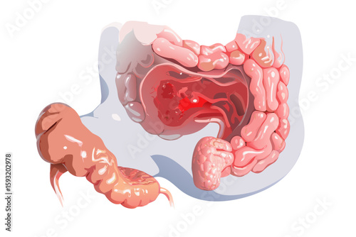 Illustration of the human colon with inflammation and a visible lesion isolated on white background