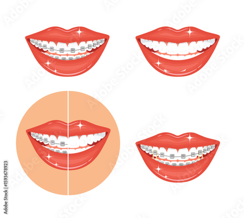 Teeth with braces. Vector. Comparison of braces and aligners. Braces with elastic / rubber bands. Isolated illustration.