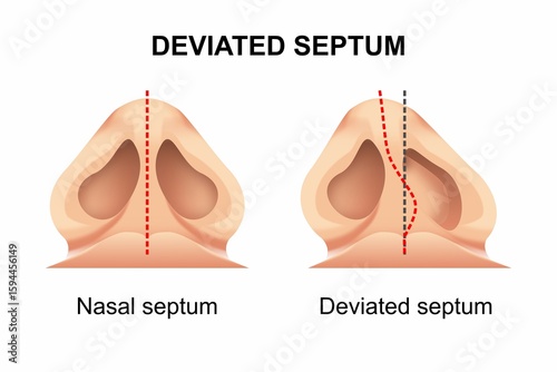 Photos Deviated Septum Nose Surgery Illustration
