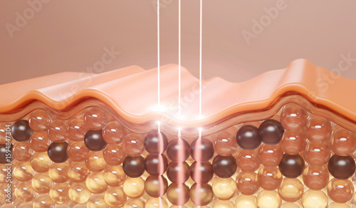 3D illustration of laser treatment targeting dark pigmented cells in skin. Skincare and dermatology concept for pigmentation, melasma, and spot removal.

