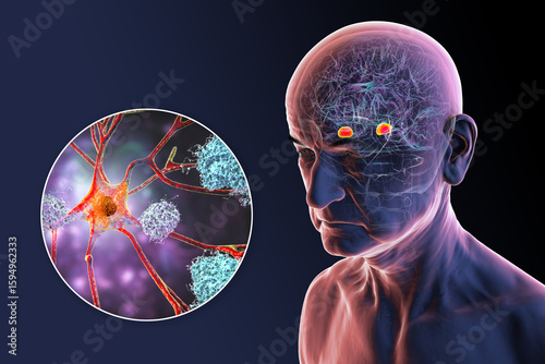 Cuadro en lienzo Senior person with Alzheimer's disease, 3D illustration showing highlighted amyg