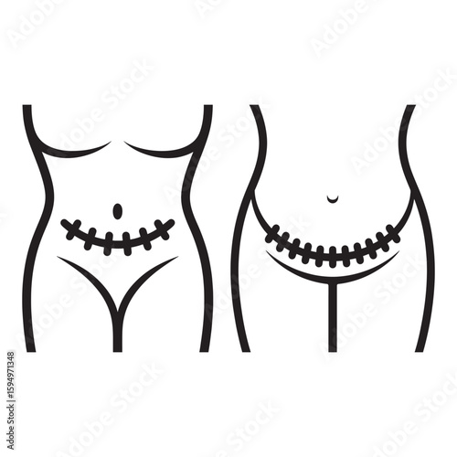 Female abdomen surgical scar comparison incision suture