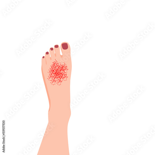 Medical vector illustration of a human foot with a red rash or skin infection. Suitable for dermatology, podiatry, skin disease, or health care topics