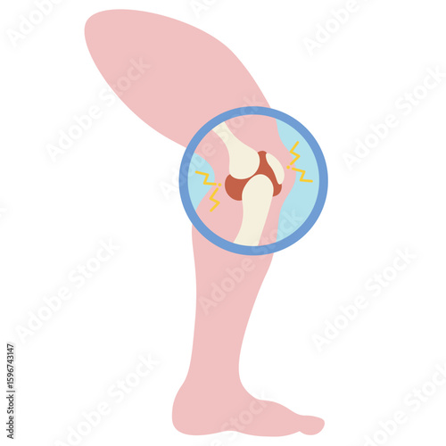 Arthritis leg vector illustration showing joint pain, swelling, stiffness; includes related conditions like osteoarthritis, rheumatoid arthritis, and gout. Minimalist medical design. pain