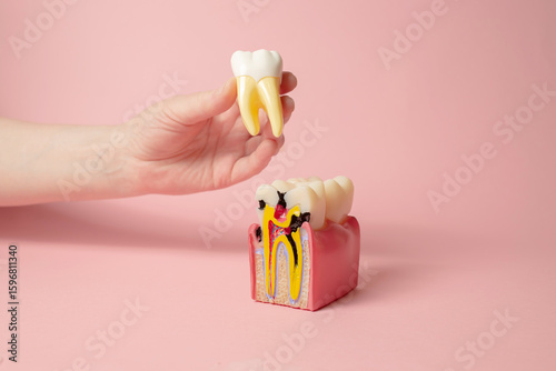 Dental 3D model of the oral cavity in section. On the model there is a tooth damaged by caries. Creative concept on a pastel background