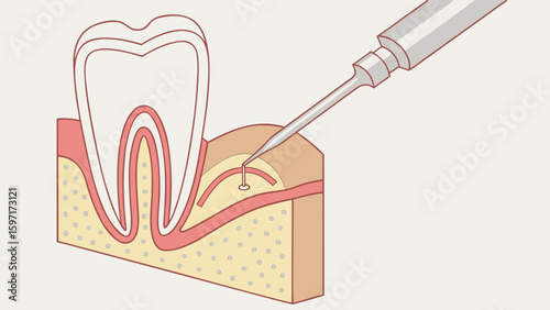 Illustration of a tooth with a dental instrument probing the gum line for dental examination or treatment