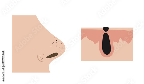 Blackheads clogging pores on nose and anatomical detail of comedo formation