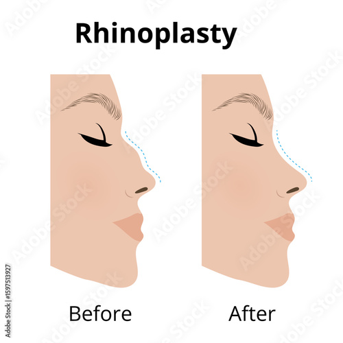 Rhinoplasty, woman showing nose before and after cosmetic surgery