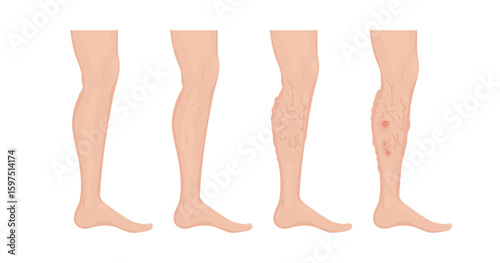 Stages of varicose veins developing on human leg, from healthy skin to thrombophlebitis