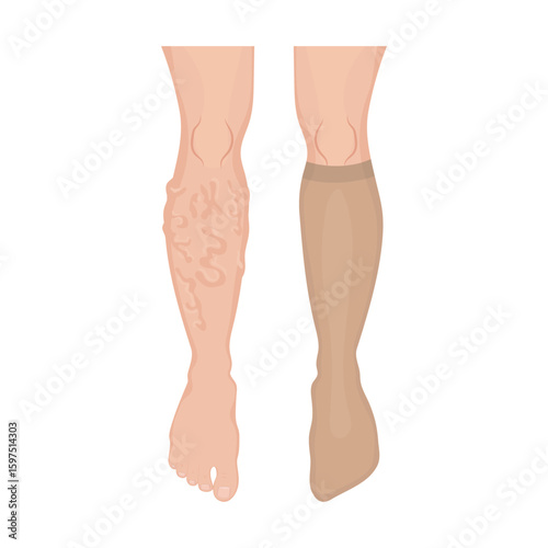 Compression stockings covering varicose veins on human leg