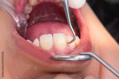 Tableau sur toile Macro image of dental scaling on lower anterior teeth using a metal scaler to remove plaque and calculus near the gum line