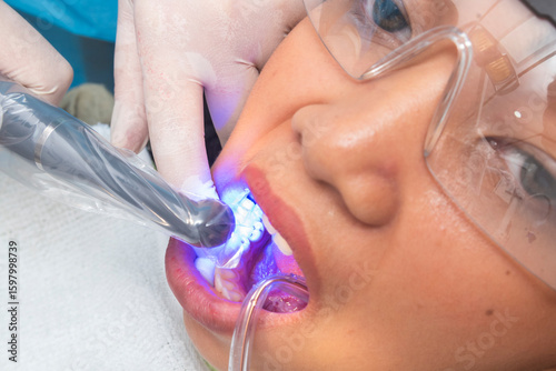 Bilde på lerret A dentist uses a polymerization light to cure composite material during the filling process on a patient's lower premolar tooth