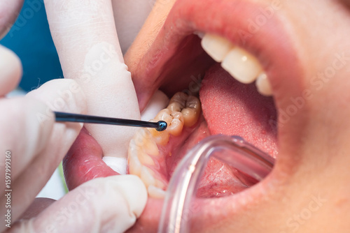 Canvas Print A dental professional places composite resin into a prepared cavity on the lower premolar using a ball burnisher or applicator