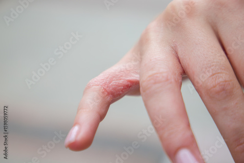 Close-up view of the fingers of a girl with dyshidrotic eczema. Selective focus.