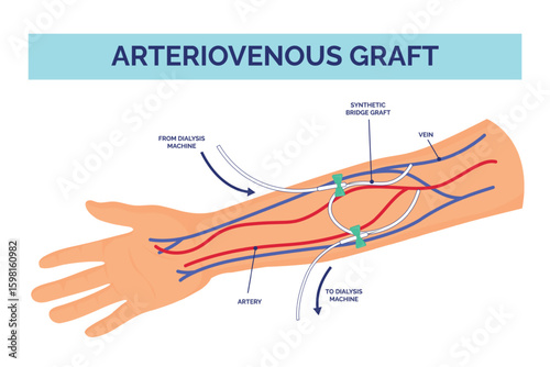 Arteriovenous graft. Venous fistula catheter, central blood acces hemodialysis machine dialysis surgery malformation disease treatment arm vein infographic vector illustration
