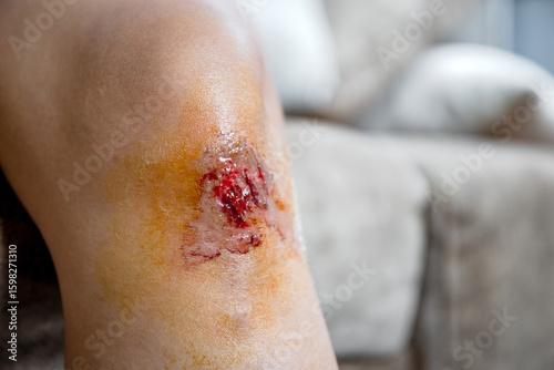 Knee wound, Fresh wound on my knee is from an accident, Skin wound, Representing wound care, First aid, and personal health, close-up