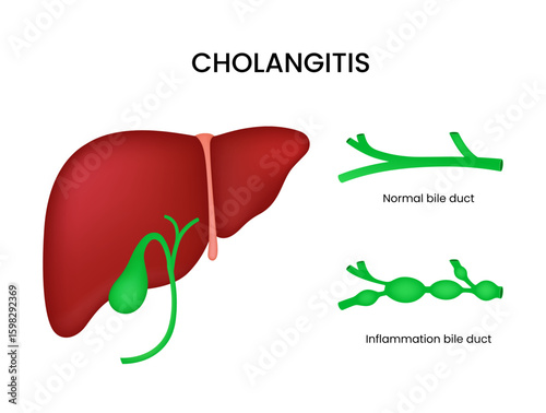Cholangitis Inflammation of Bile Ducts