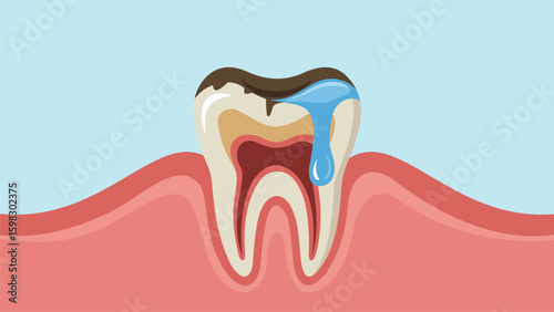 Tooth Decay Illustration of a Decaying Tooth with Water Droplet
