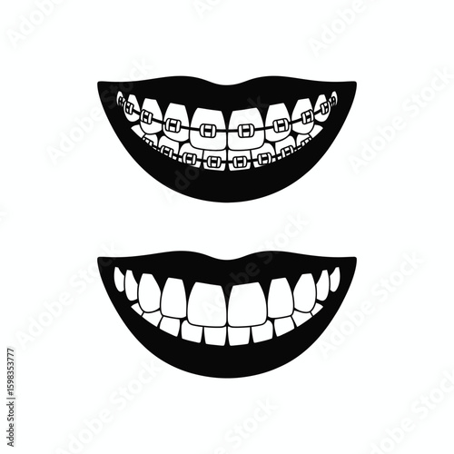 Before and after braces comparison of smiling mouths