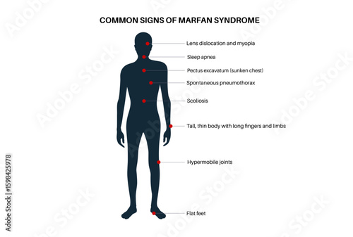 Marfan syndrome poster