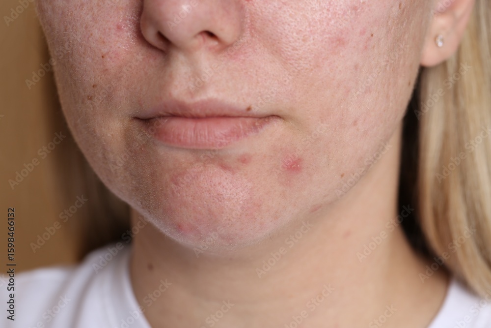Naklejka premium Woman with acne problem on beige background, closeup