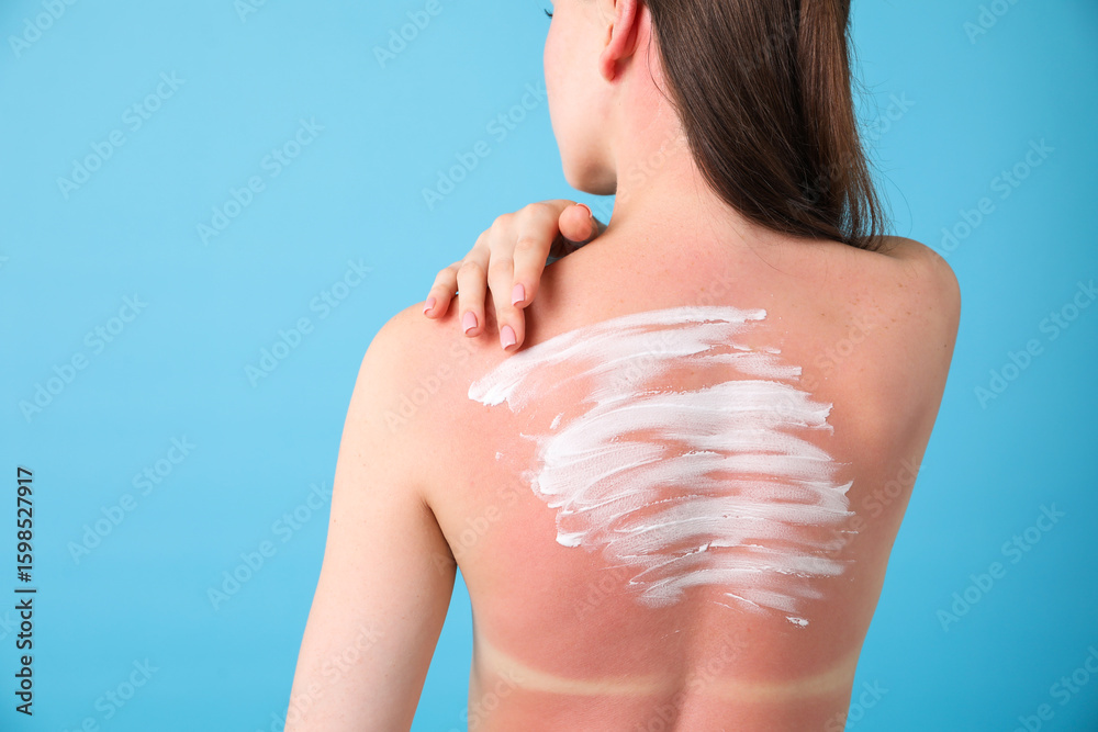 Fototapeta premium Woman with sun protection product on her sunburned skin against light blue background, back view. Space for text