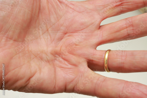 Senior Man with Dupuytren Contracture on the palm of his hand