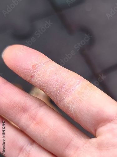 Woman's finger on the hand with eczema . High quality photo