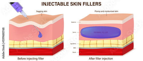 Injectable skin fillers. Dermal fillers. Skin before and after injecting of filler. Treatment of Aged Skin. Vector for advertising about beauty and medical treatment.