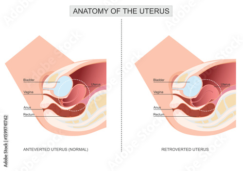 Anteverted uterus different than a retroverted uterus.Retroverted uterus.
