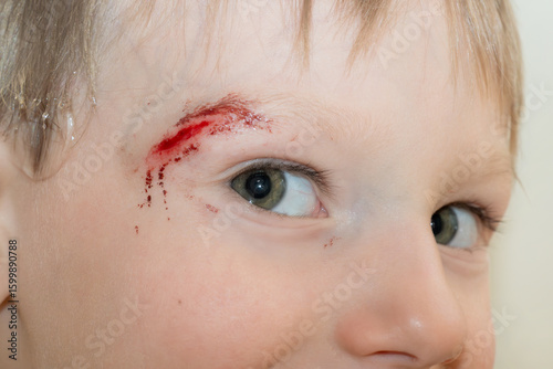 Close-up of the boy's face with a sadina. The child treats the wound on the face. High quality photo