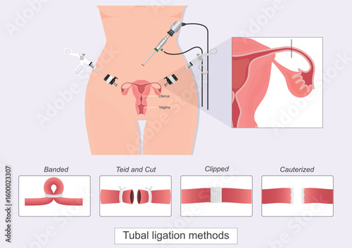Tubal ligation is a type of permanent birth control.