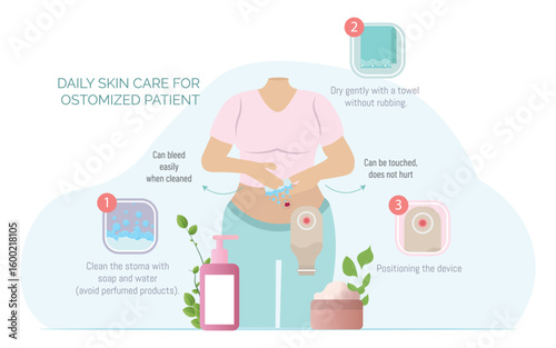 Patient cleaning stoma with soap and water, ostomy care instructions