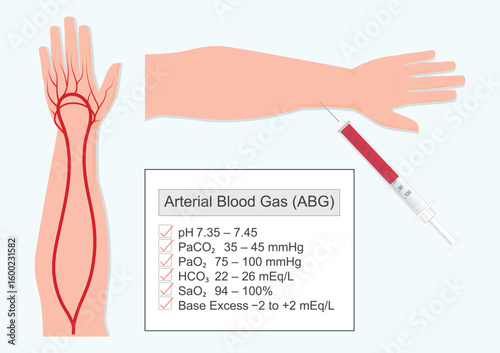 An arterial blood gas (ABG) test measures the oxygen and carbon dioxide levels in blood.