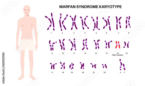 Marfan syndrome poster