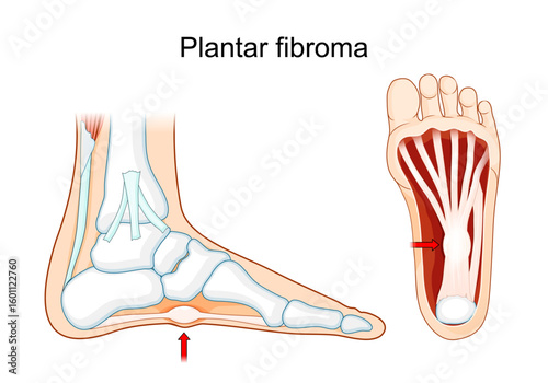Plantar fibroma. Plantar fascial fibromatosis
