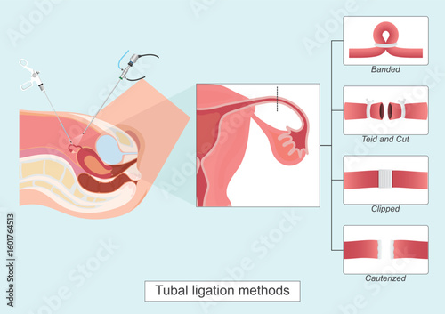 Tubal ligation or getting tubes tied, is a permanent way to prevent pregnancy.