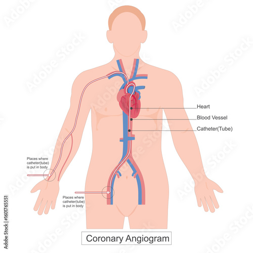 A Coronary Angiogram (CAG) is a crucial diagnostic technique.