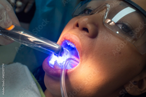 Final polymerization phase of dental composite using curing light on a lower premolar to harden the restoration material securely.