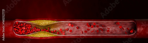 Hyperlipidemia or arteriosclerosis. Blocked artery concept and human blood vessel as a disease with cholesterol fat buildup clogging. Clogged arteries, Cholesterol plaque in the artery. 3D Rendering