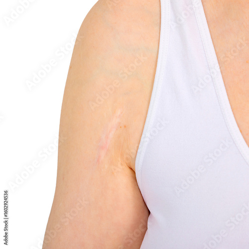 Female arm with postoperative scar on shoulder. Keloid or hypertrophic scar after surgery. Shoulder surgery concept, shoulder replacement.